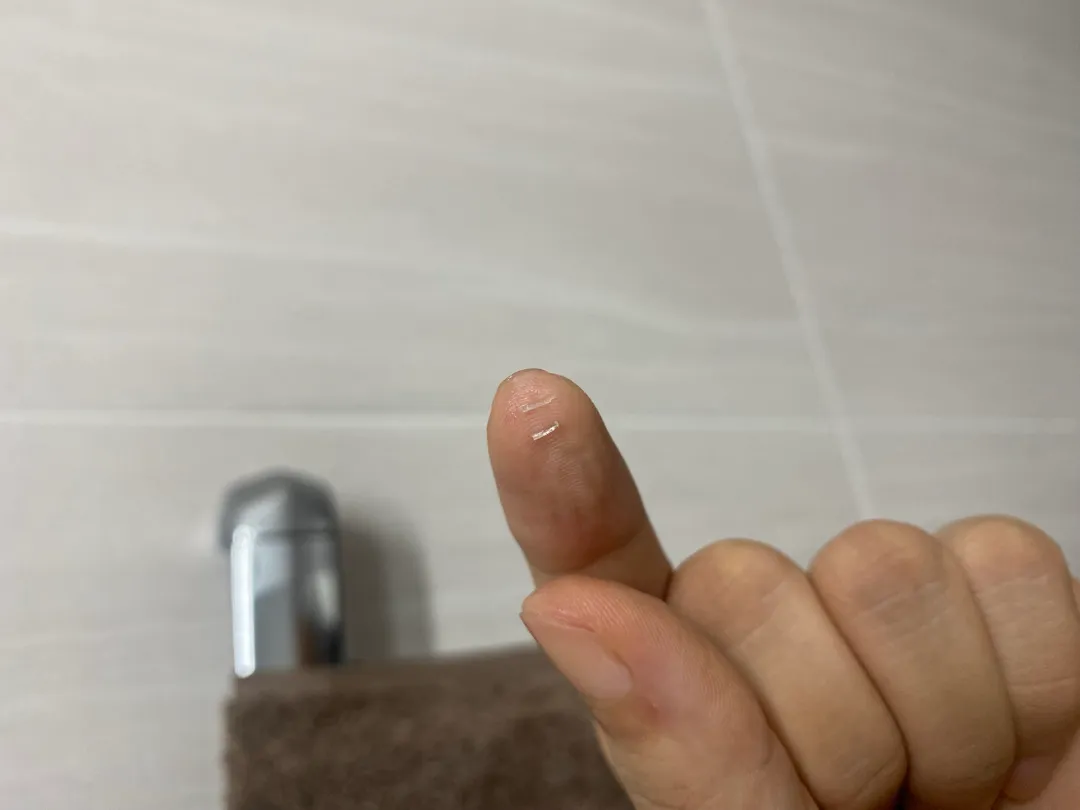제왕 한달차 녹는실이 빠져나온거같아요