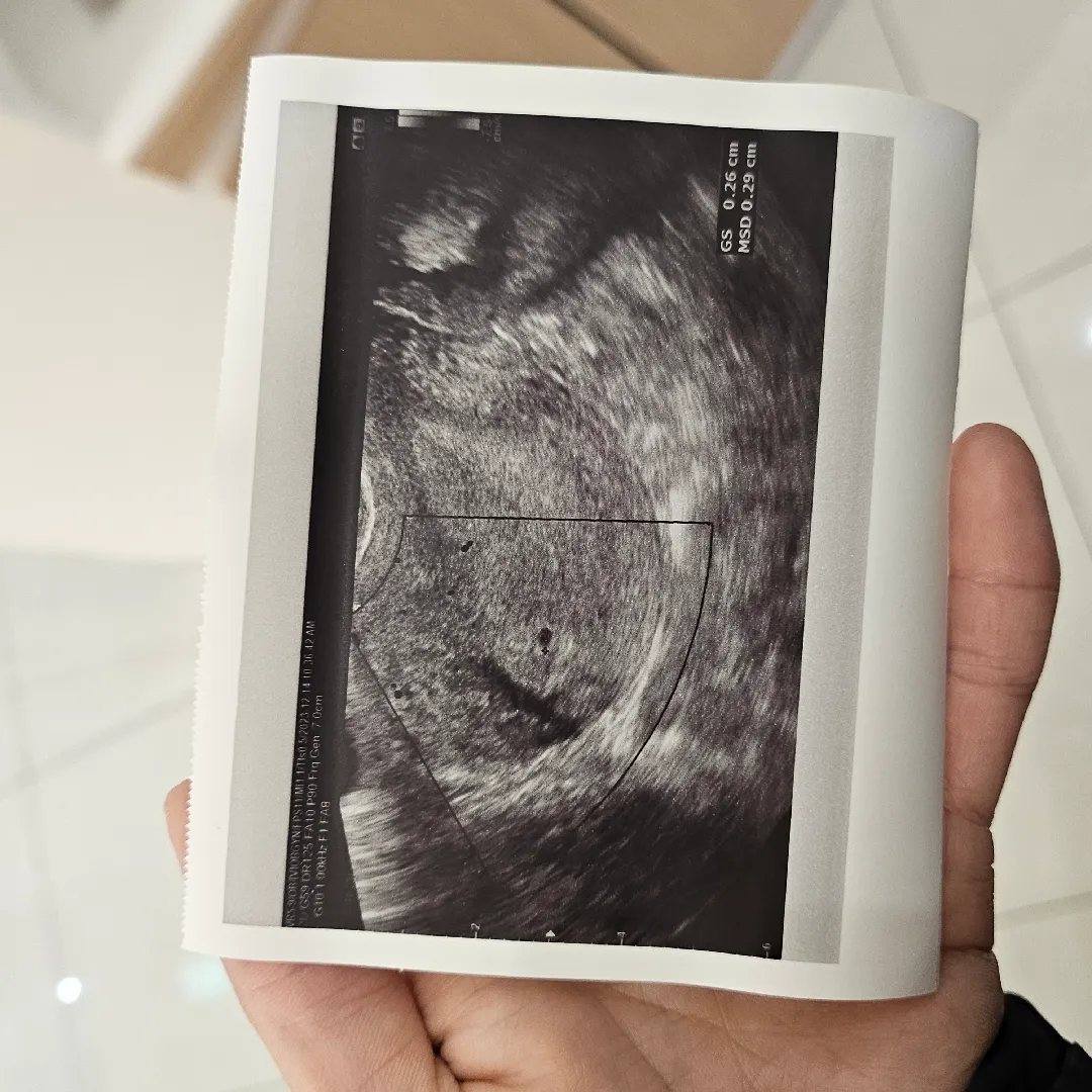 4주4일차 아기집 크기 괜찮나요?