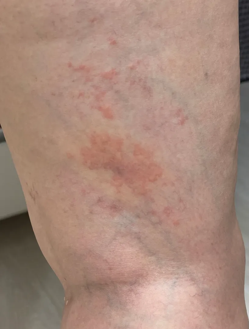 36주 다리 두드러기 붓기 퍼짐