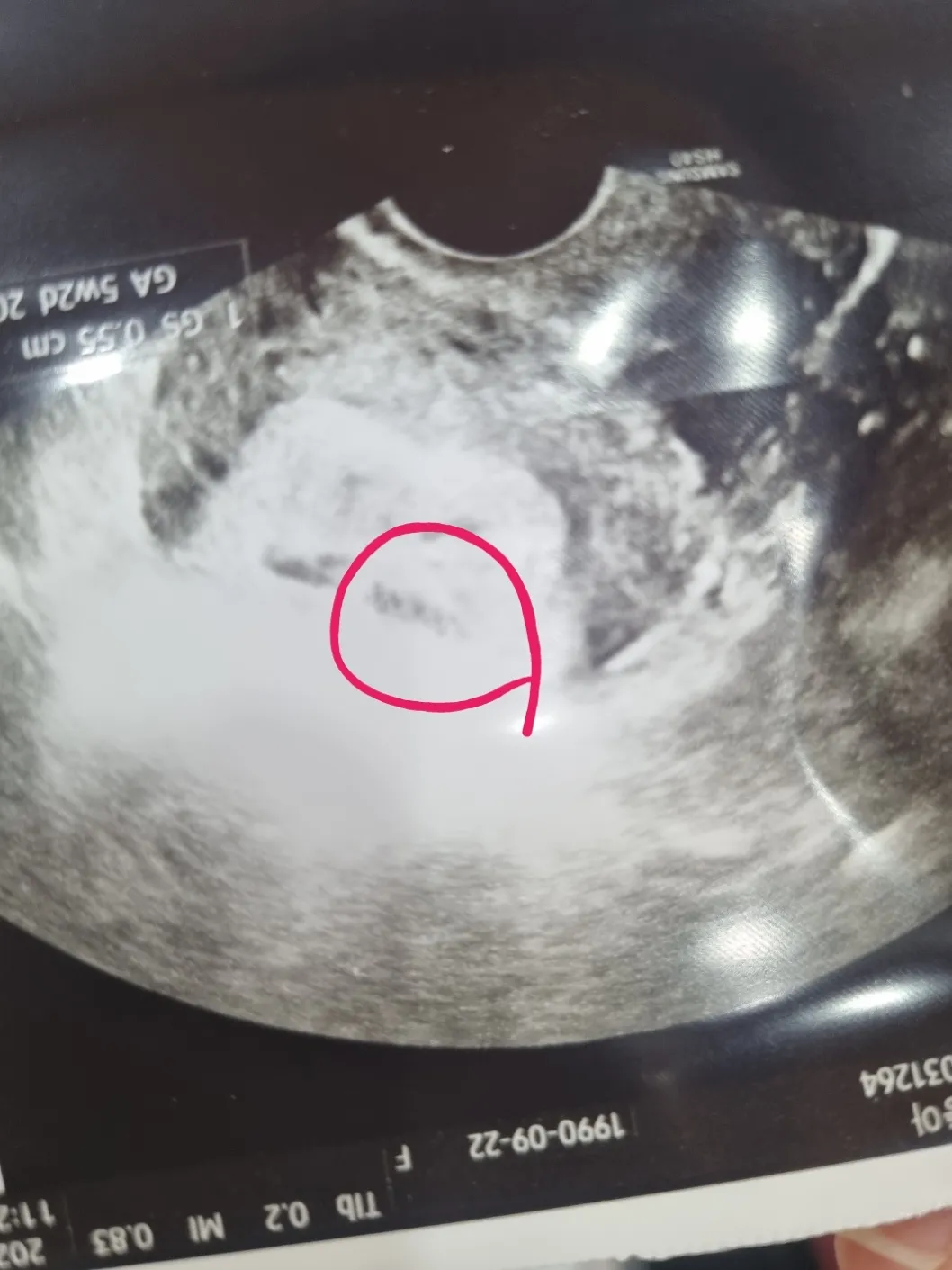 초음파사진이...ㅜㅜ