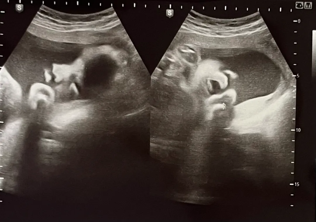 어제 병원 다녀왔는데 눈 뜨고 혀도 내밀고 있는 30주 아가 콩닥이 ㅎㅎ