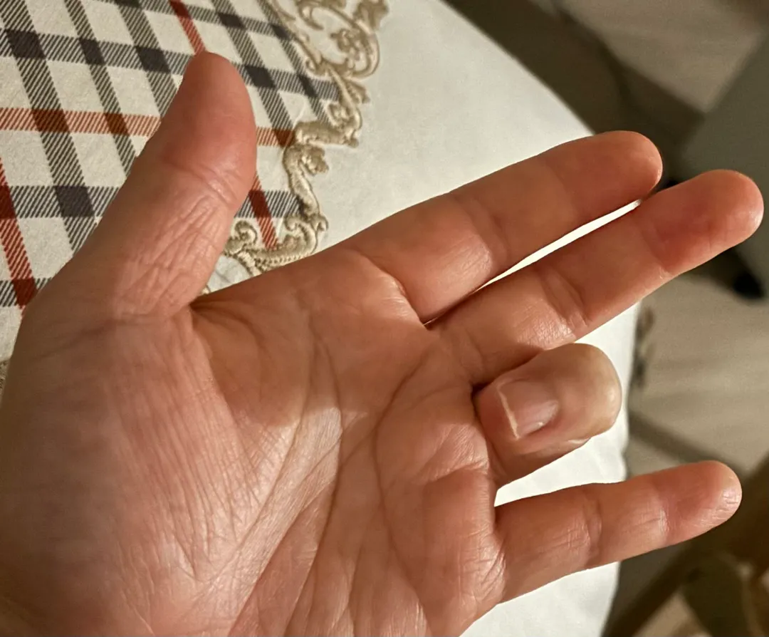 출산 후 손가락 버벅? 거림ㅠㅠ