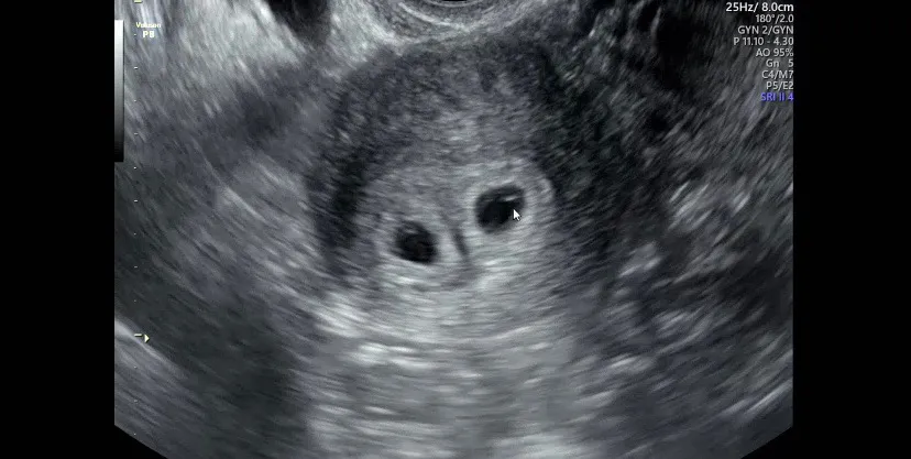 5주 3일차 쌍둥이 아기집 보고왔어요!