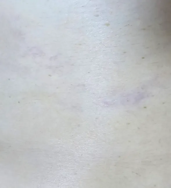 임산부 파란 실 핏줄??
