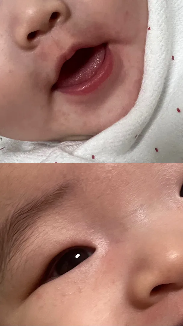 5개월차 아기 피부 ㅜㅜ 
