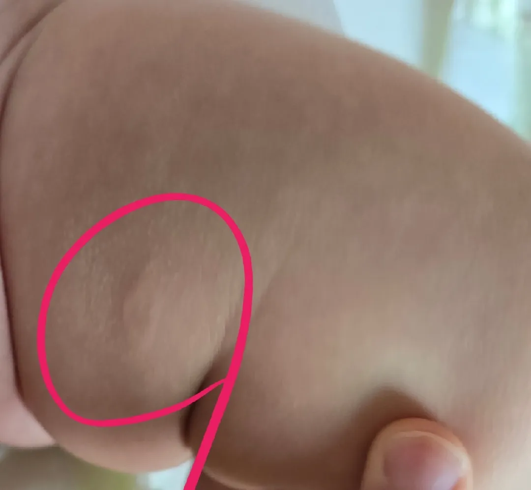 허벅지에 뭐가 났는데 이게 뭘까요?