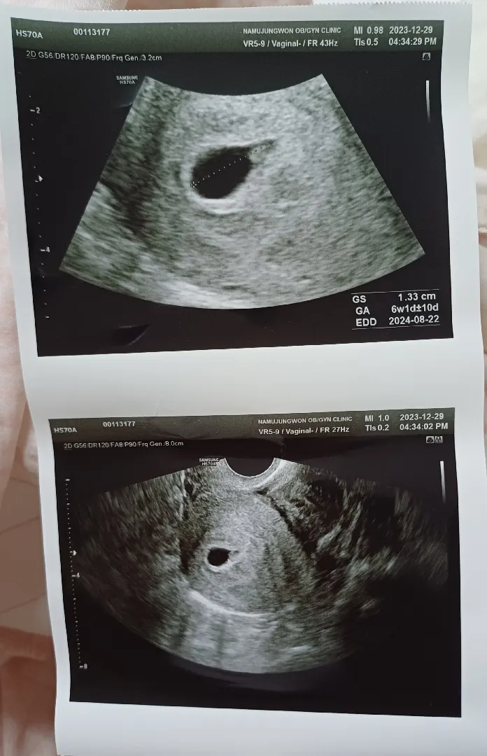 초음파 봐주세요!!