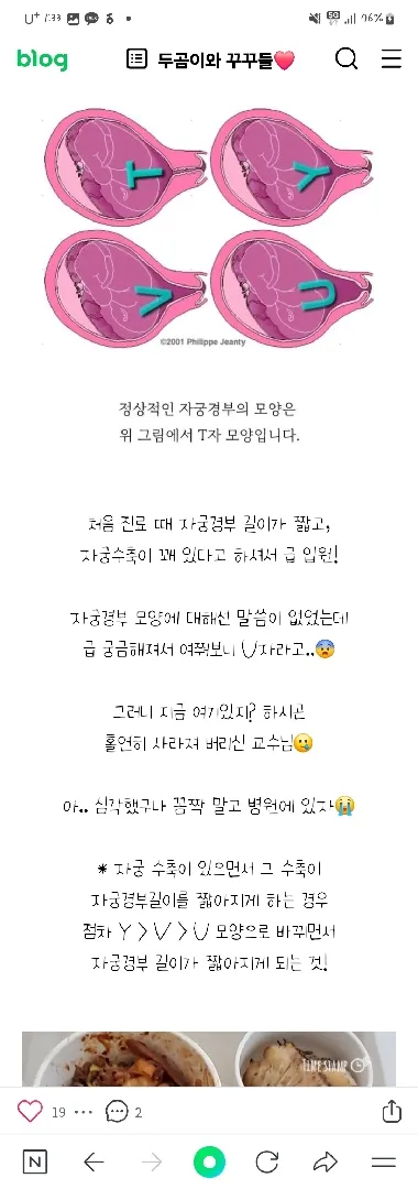 자궁경부입구가 열리기직전 이래요...