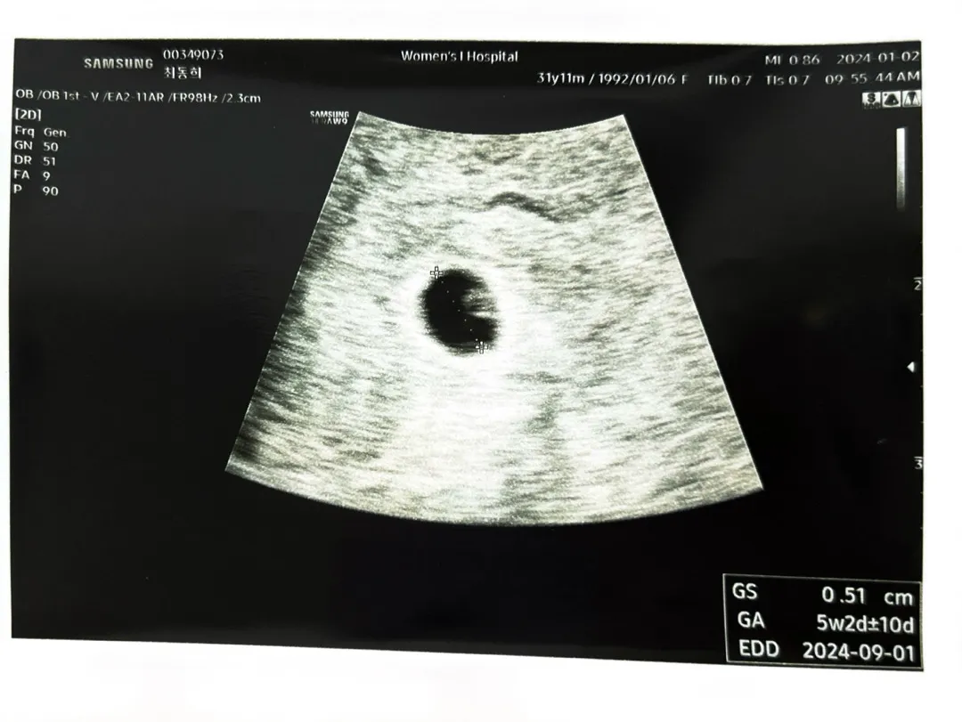 5주 2일 초음파