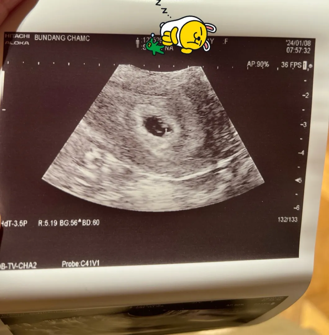 (5주4일) 아기집과 심장뛰는 선물이🫶🏽