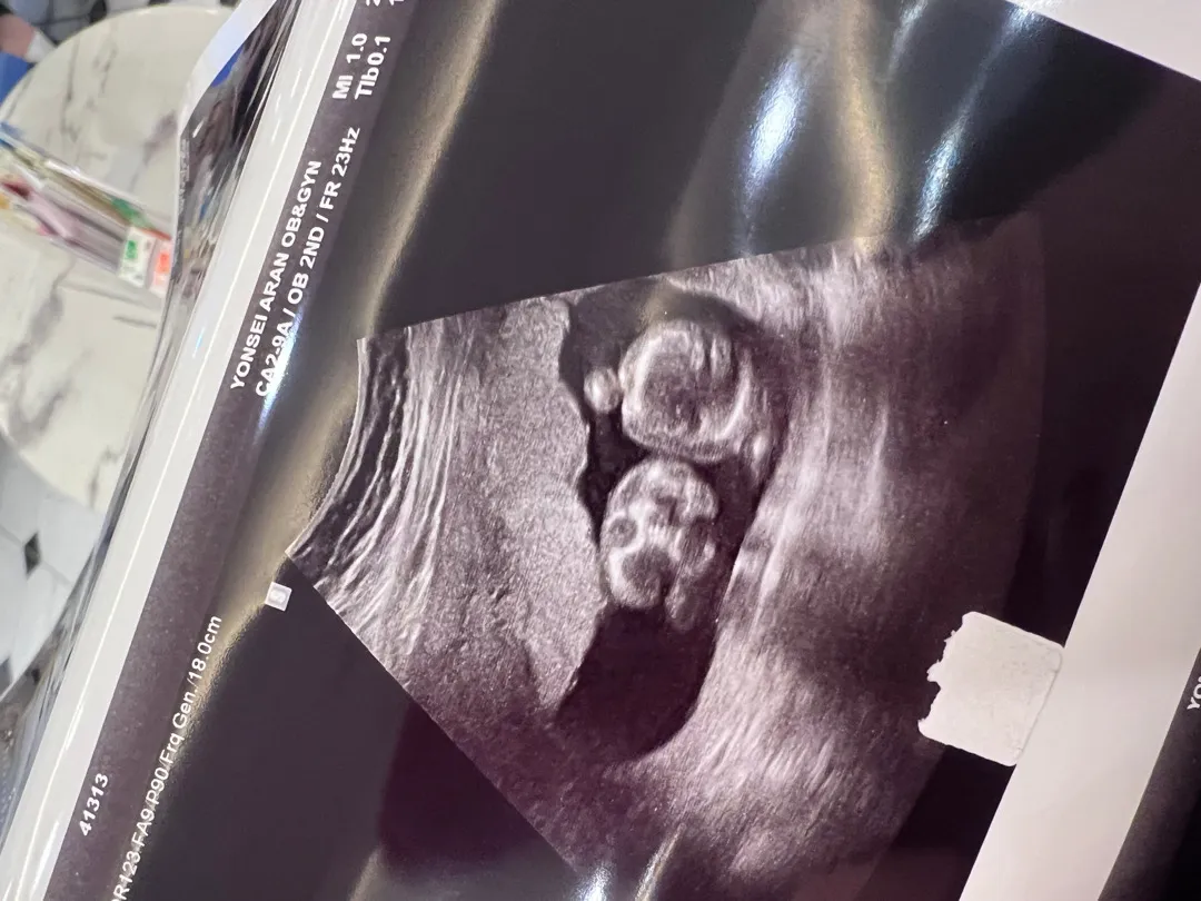 (16주5일)2차기형아,해골바가지 선물이💀