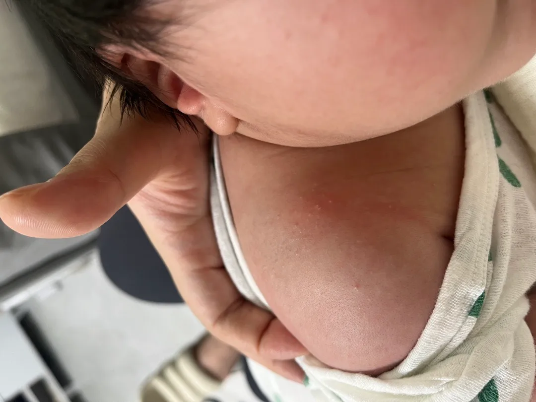 신생아 피부좀 봐주세요ㅠ