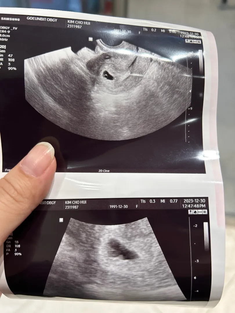 5주3일차 심한 복통 병원다녀왔어요