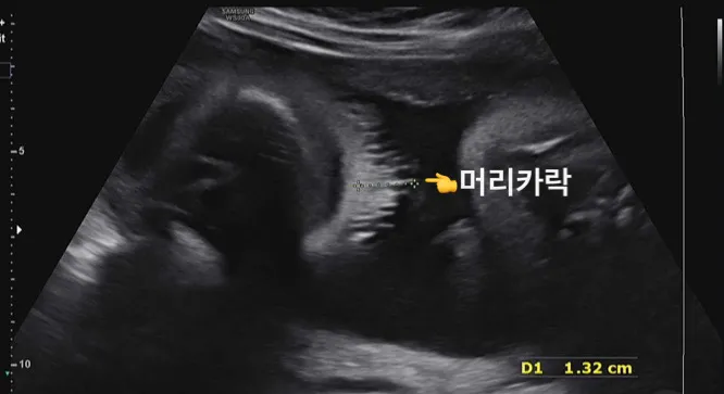 28주 머리카락