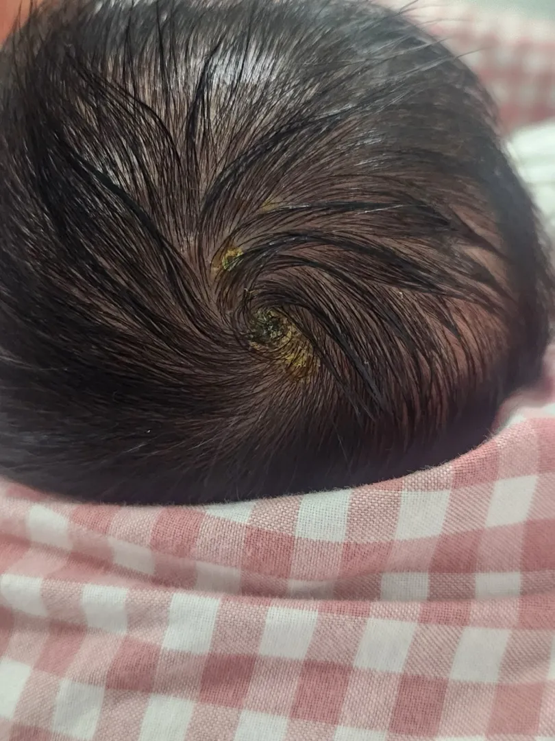 신생아 정수리부분 고름 어떡하죠..?