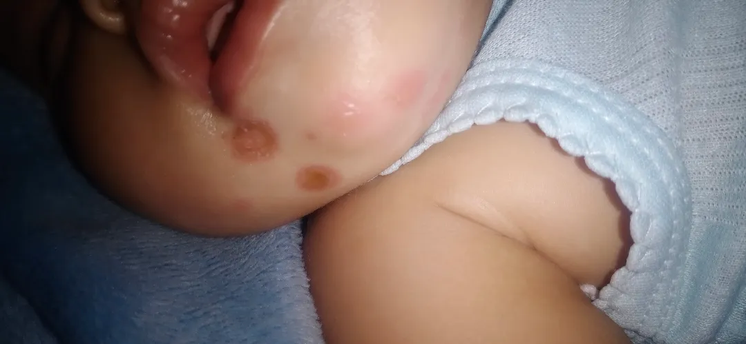 Luka diwajah bayi