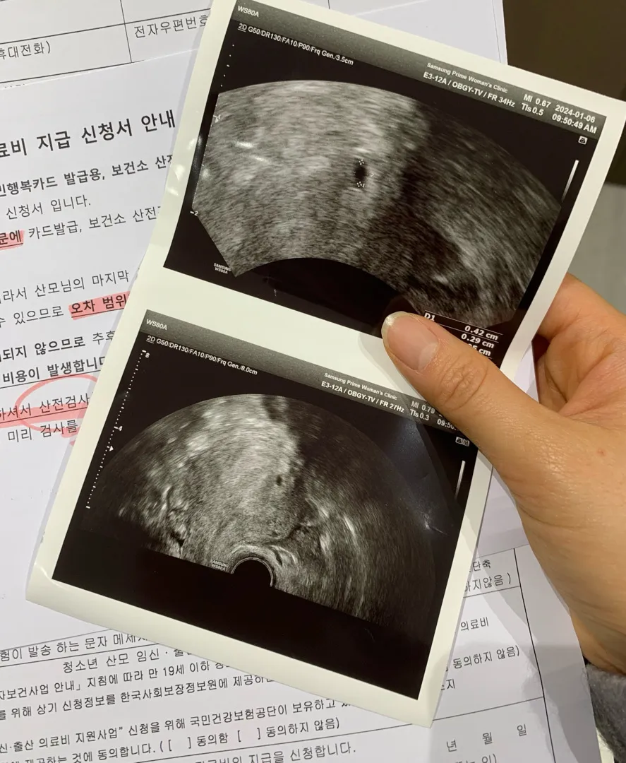 5주0일차 아기집 보고왔어요~