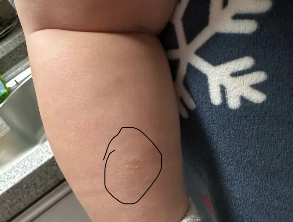 아기 다리에 이거 뭘까요?