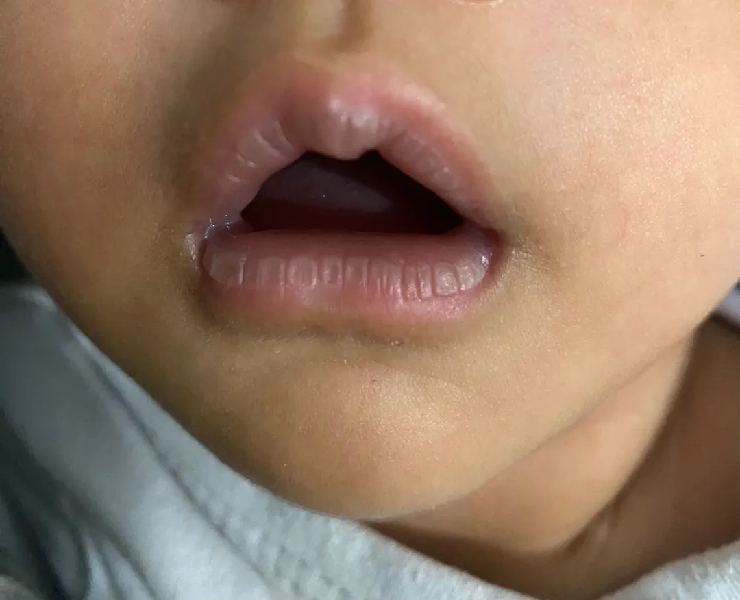Bibir kering
