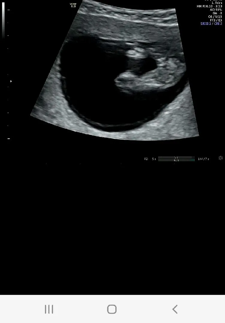 13주5일 딸 반전