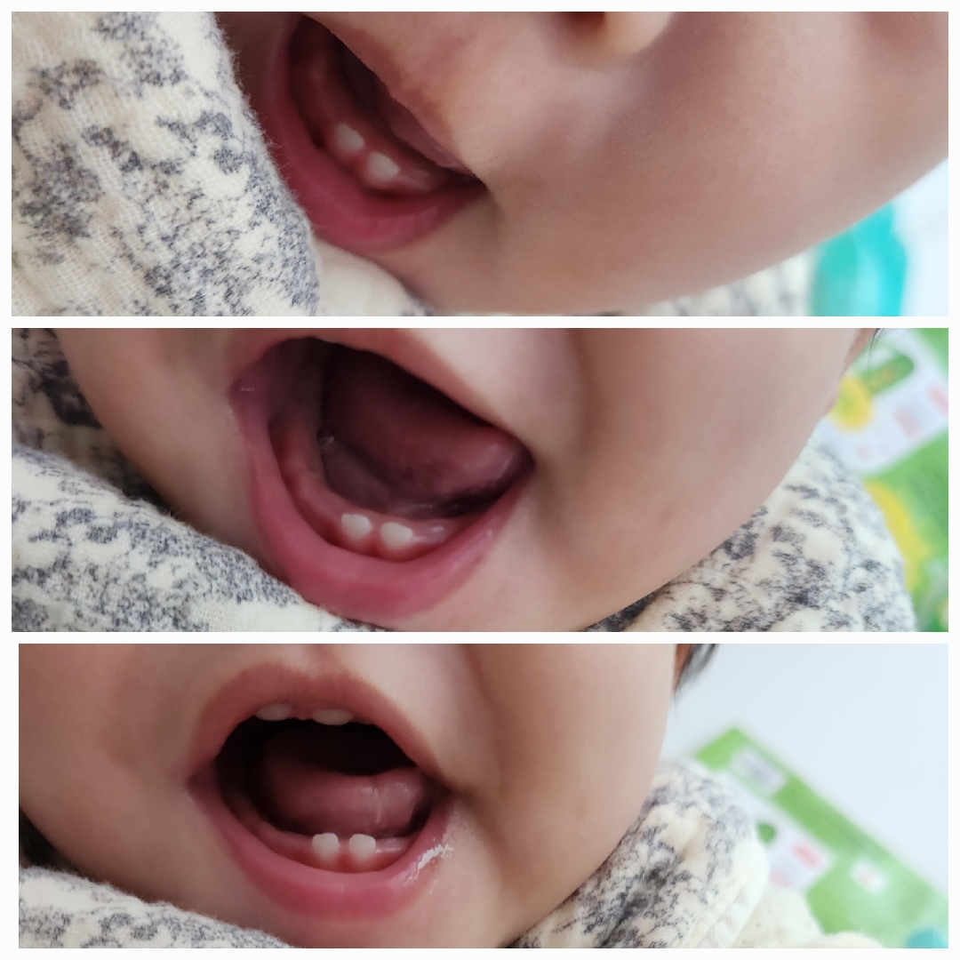 245일 아기 치아 6개 나는거 괜찮나요?...