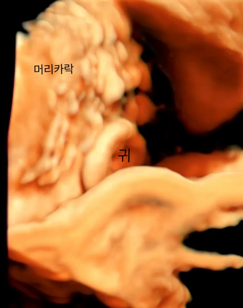 파워 곱슬머리 태아 입체초음파 ㅎㅎㅎㅎ