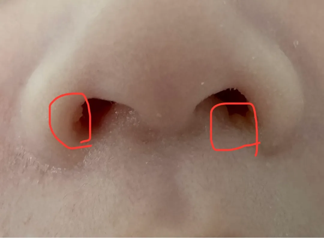 아기 콧속 좁살여드름??