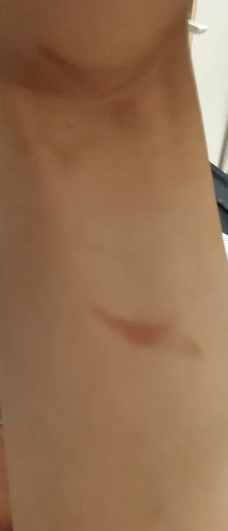 이것도 튼살인가요?