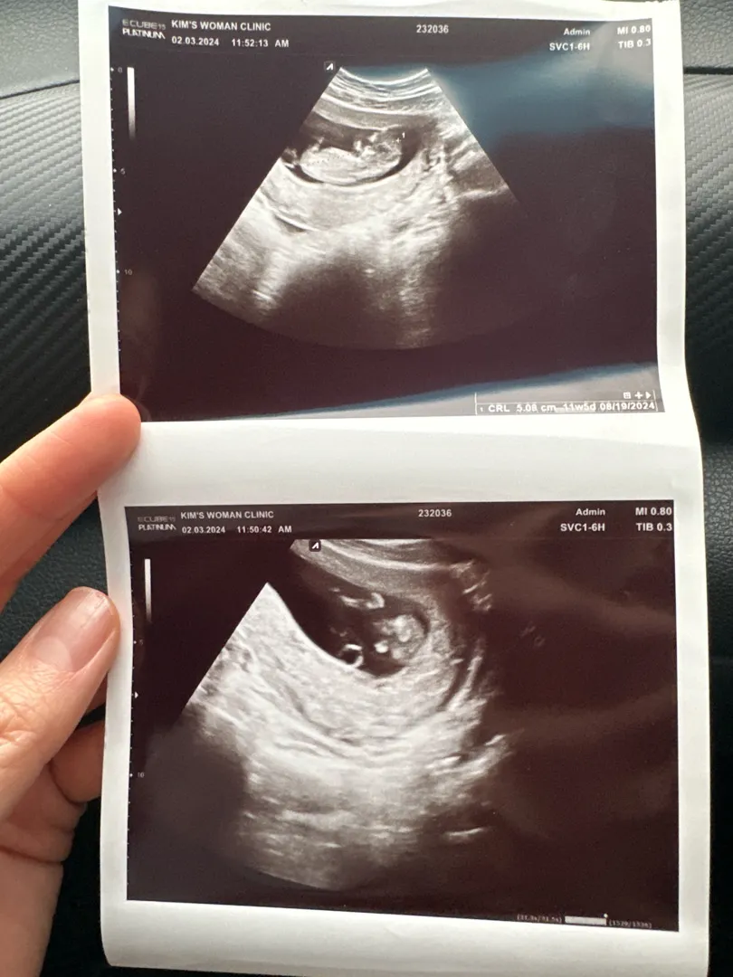 11주 5일 초음파예요~~!
