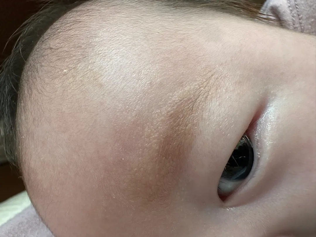 각질? 아토피?