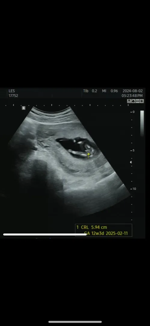 12주 3일 각도법 로케트 맞나요?? 