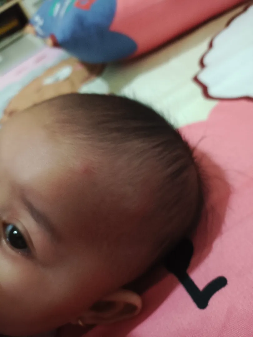 Ngilangin bekas gigitan nyamuk