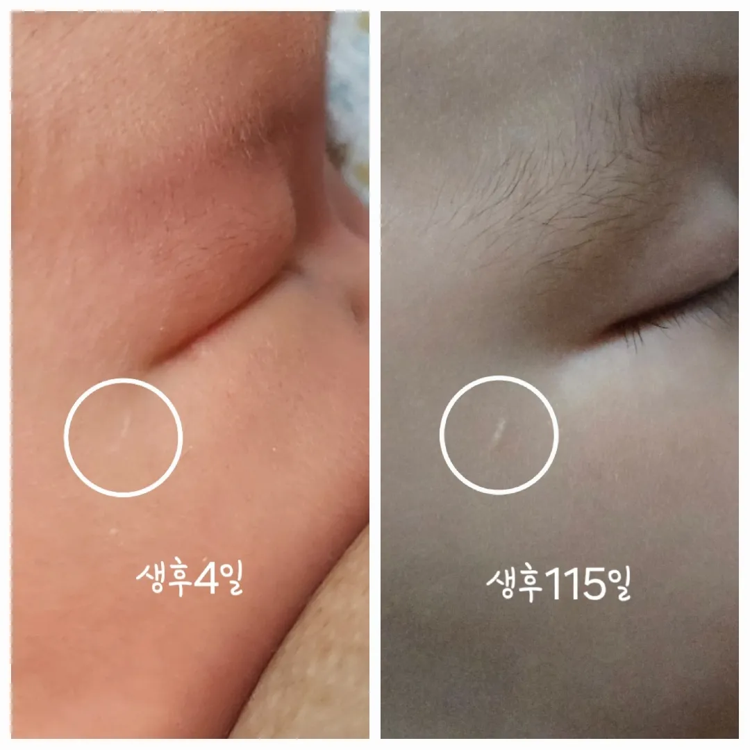 조리원에서 생긴 흉터?+혈관종