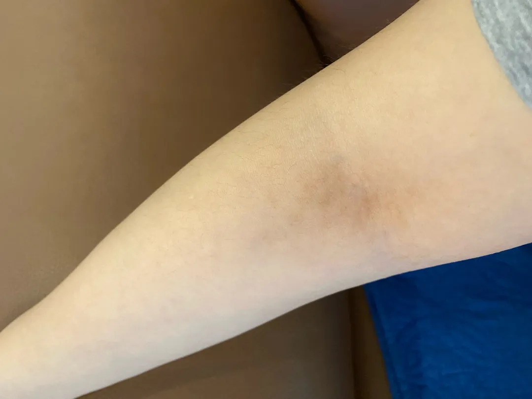 겨드랑이 팔 갈색 점 ㅠㅠ 
