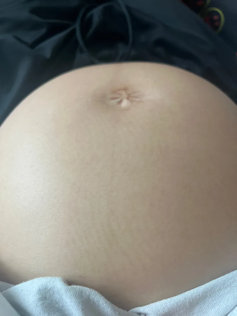 30주 배에 물결무늬가 생겼는데 뭘까요?