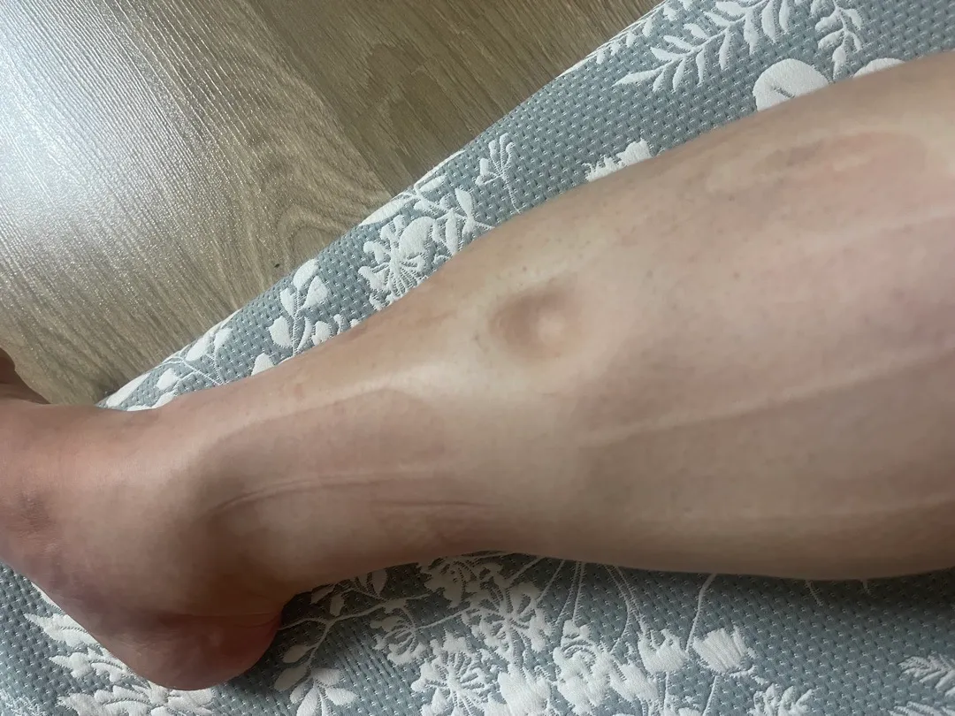 다리붓기
