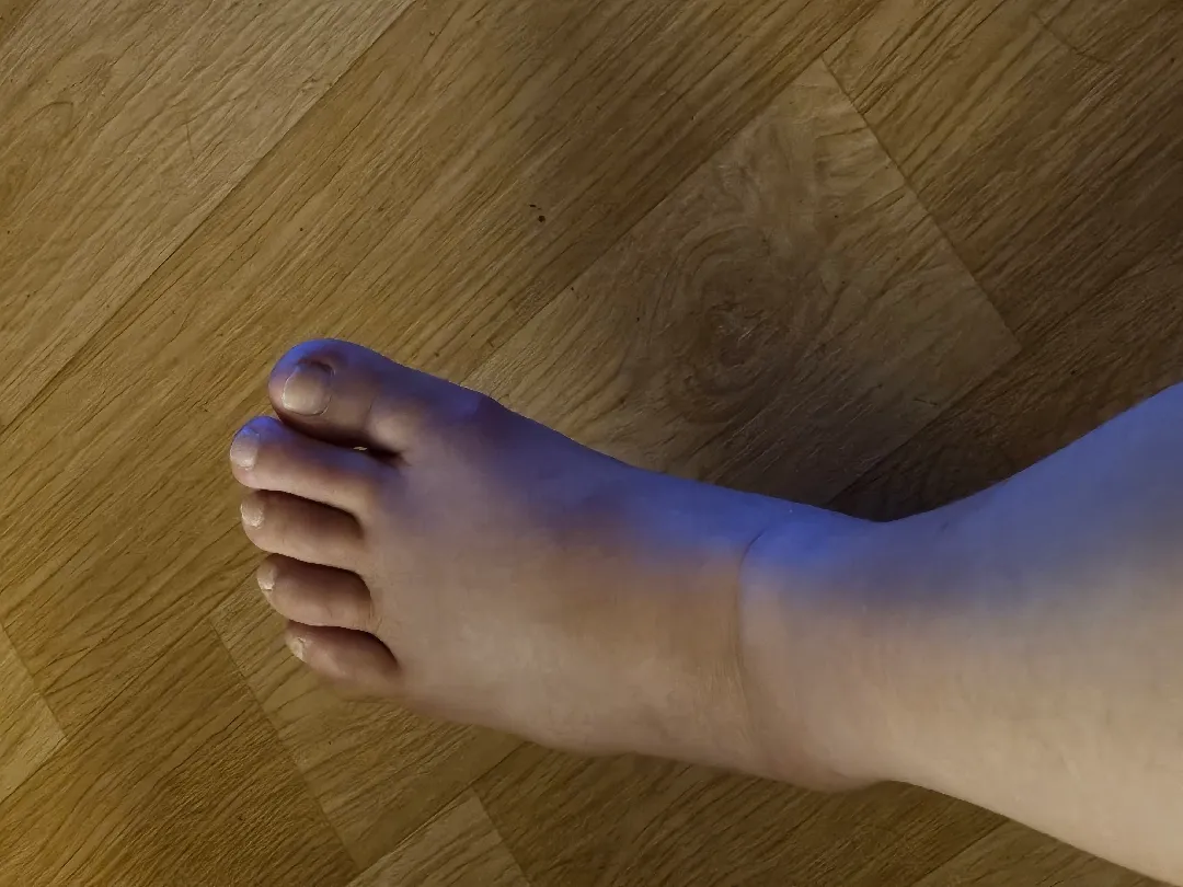븟기가 갑자기 심해졌어요