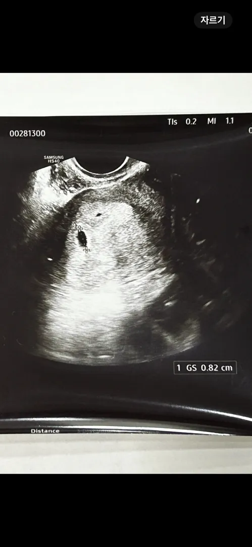 4주 3일차, 0.82cm 아기집은 너무 큰건가요…?