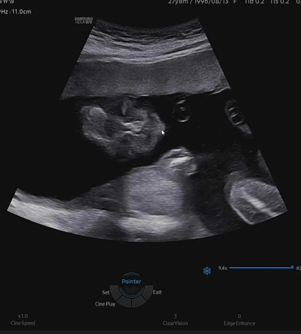 20주 애기 얼굴이 보여욤