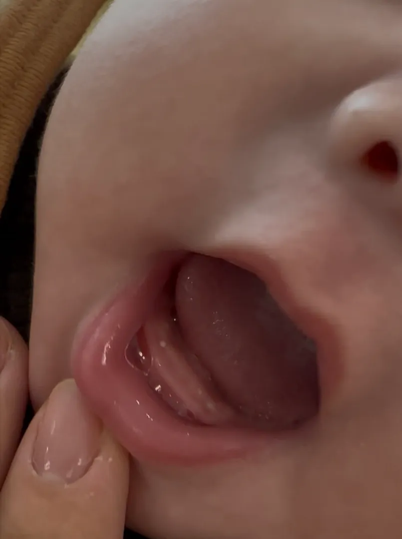 78일차 이앓이.. 말이안되죠? 