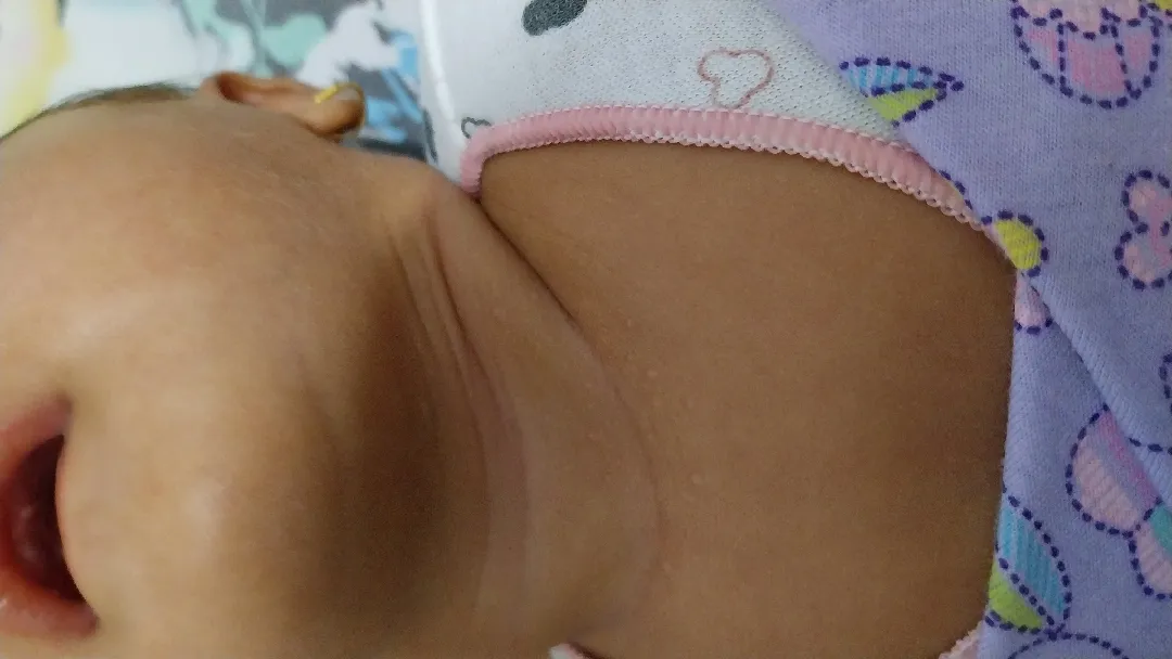 Bintik di leher bayi