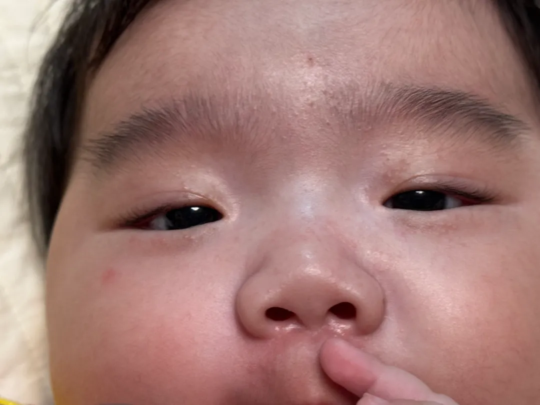 눈이 가려워 긁더니 이렇게 됐어요 ㅠㅠ