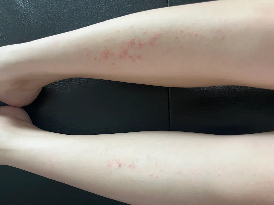 임산부 소양증?일까요?