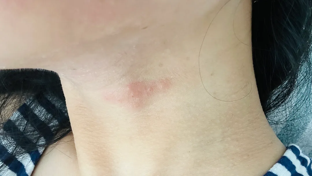 동그랗고 단단한 두드러기 나보신 분 ㅠㅠ 도와주세요