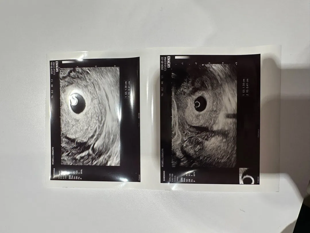 초음파사진