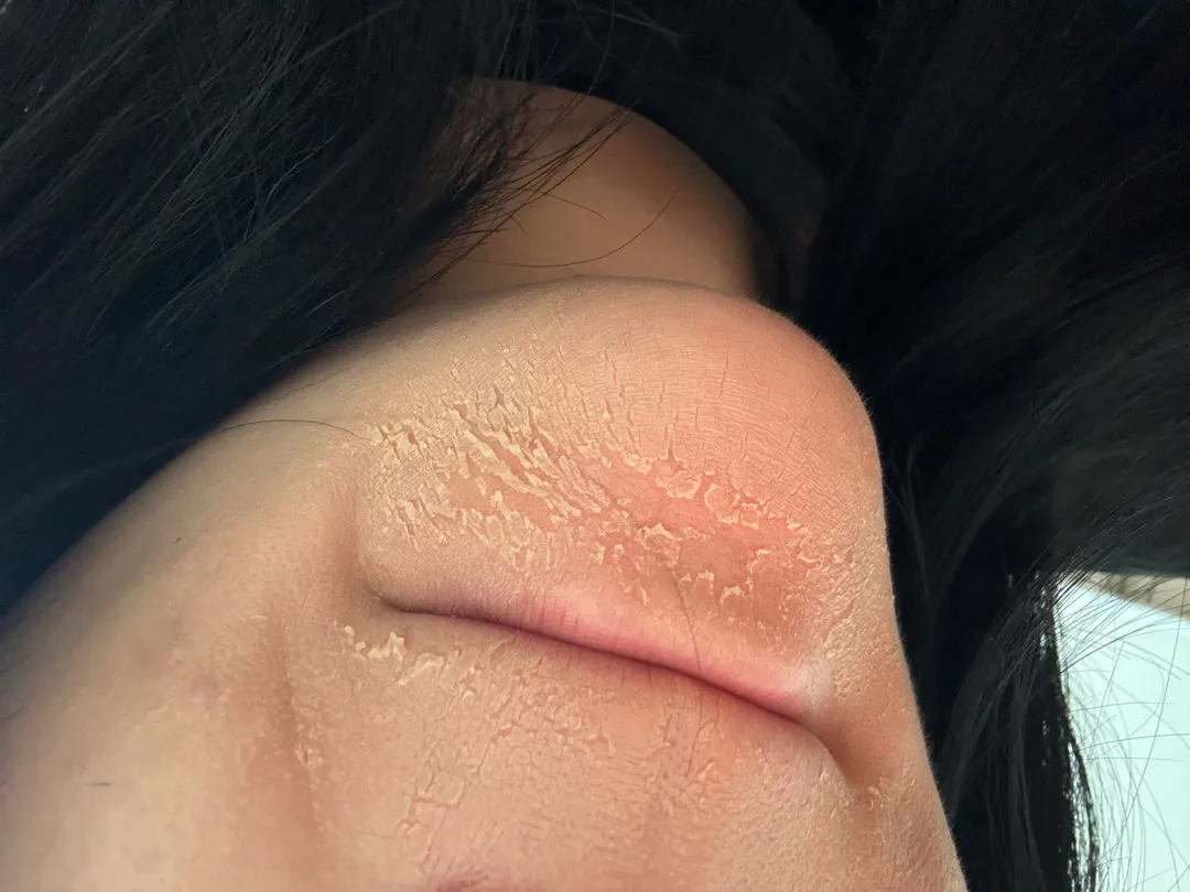 피부 ㅠㅠ