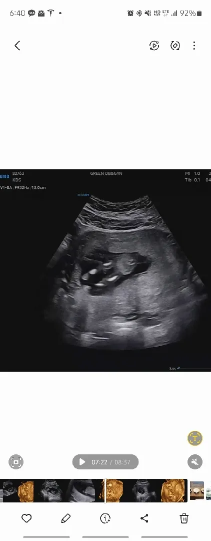 13주 1일인데..안보이는데.. 딸일까요?