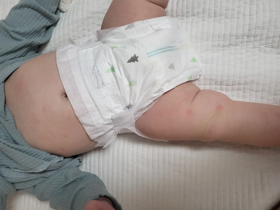 6개월아기 몸에붉은반점