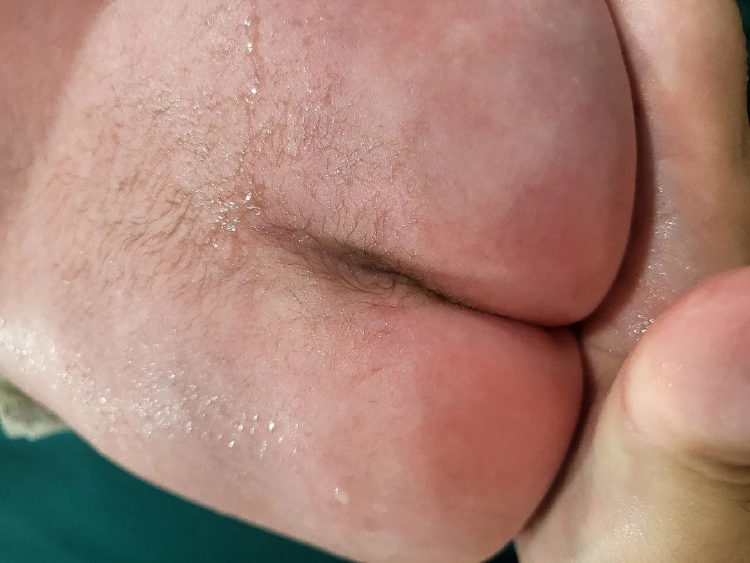 딤플