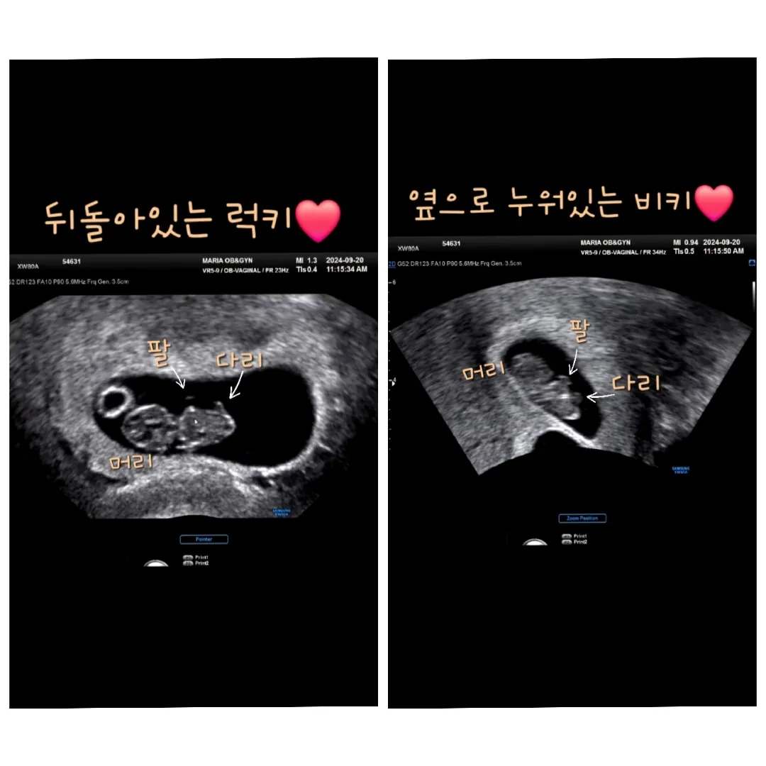 8주차 쌍둥이 초음파